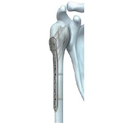 Locking Plate Periarticular Proximal Humeral 3.5 Mm, Left Right