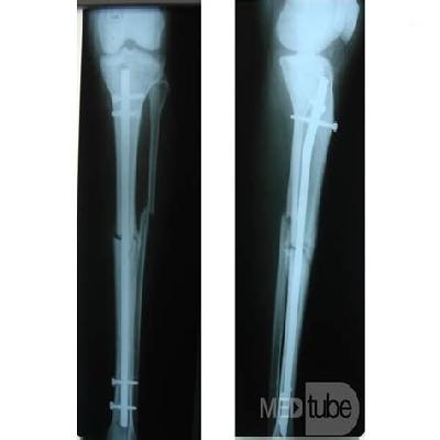 Interlock Tibia Nail