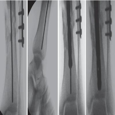 Interlock Tibia Nail Distal End