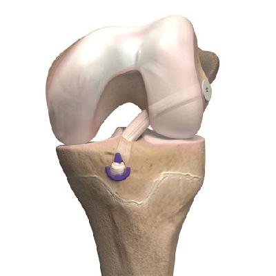 ACL Reconstruction System