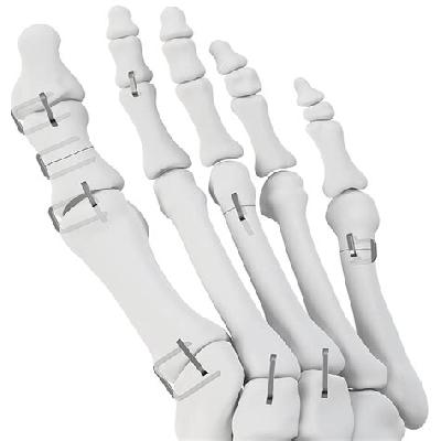 Arthroscopy Orthopedic Staple Implants