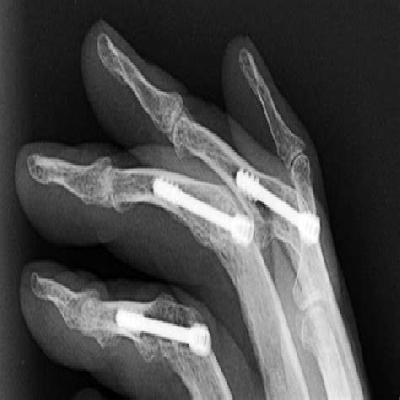 Herbert Screw