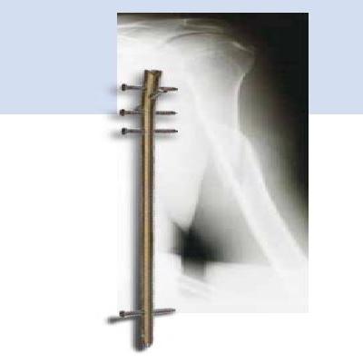 Humerus Interlocking Nail