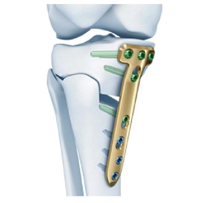 Stainless Steel Distal Radius Locking Plate