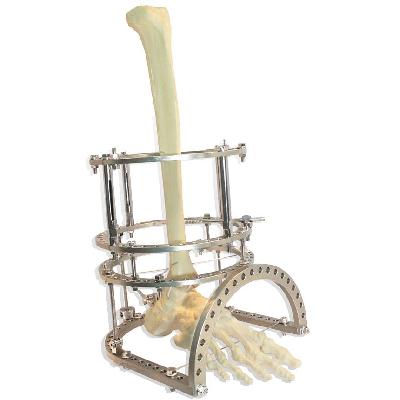 Circular External Fixator