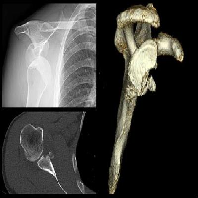 Glenoid Sleeve