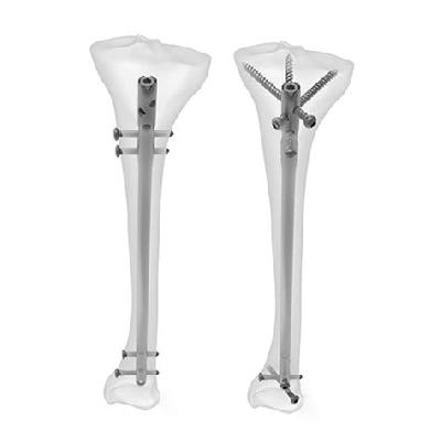 Inter Locking Tiba Nails