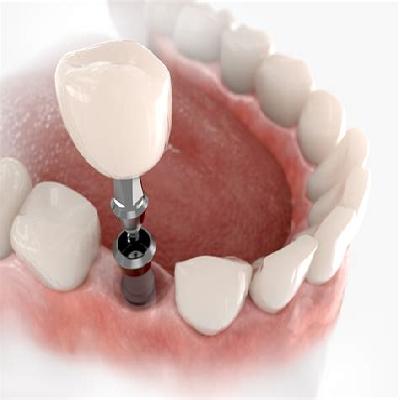 First-Class Implants With Full Service
