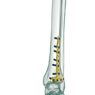 Distal Tibial Locking Plates