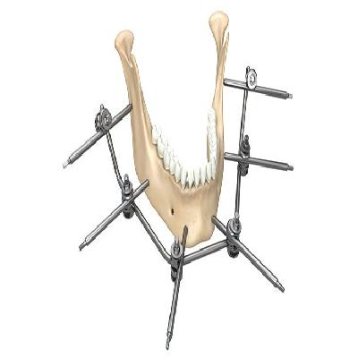 External  Bone Plates Mandibular Distractors Uni-Directional