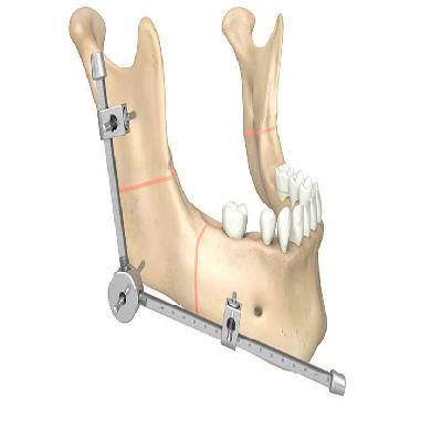 External FixatorsMandibular Distractors Bi-Directional