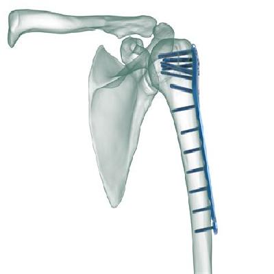 Proximal Humerus Locking Plates