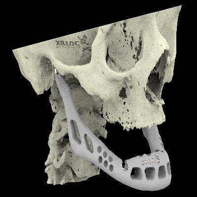 Reconstruction Plates For Full Mandible U Shape