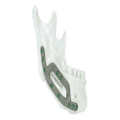 Reconstruction Plates For Mandible  Angled