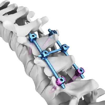 Spinal Implants