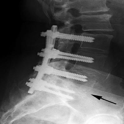 Steffi Spinal Plates