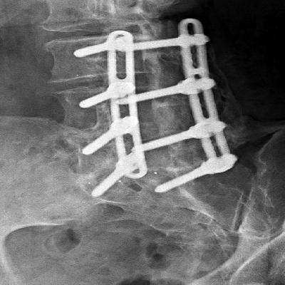 Steffi Spinal Screws