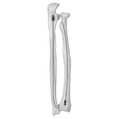 Titanium Elastic Nail