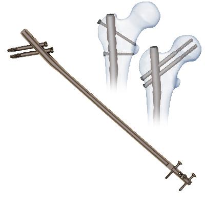Titanium Interlocking Nails For Femur