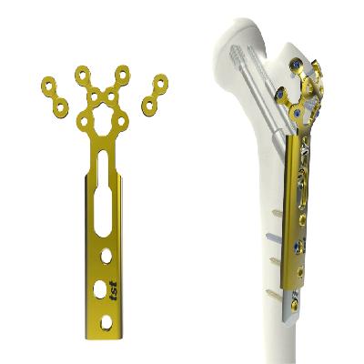 Trochanter Stabilization Locking Plate