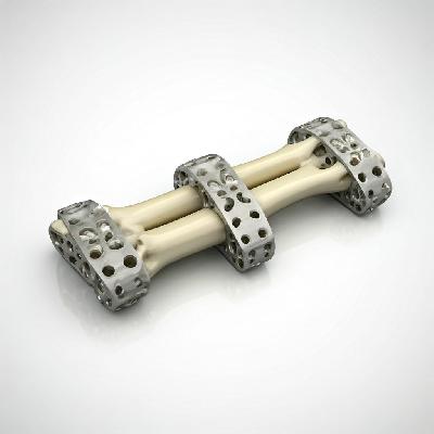 Titanium Bone 3D Plates