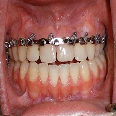 Easy Arch Bar