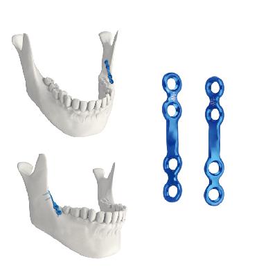 Mini Bone Straight Plate.(Maxillofacial Implant)