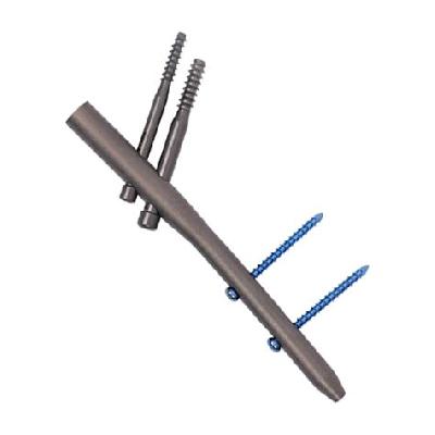 Interlocking Nail System