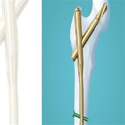 Proximal Femoral Cannulated Nail