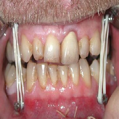 Intermaxillary  Fixation Screw IMF