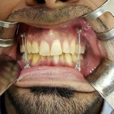 Intermaxillary Fixation Screw