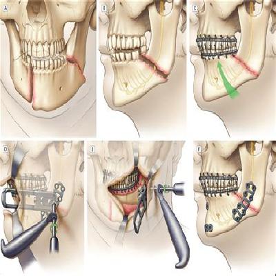 Reconstruction Plates  for Mandible Angled