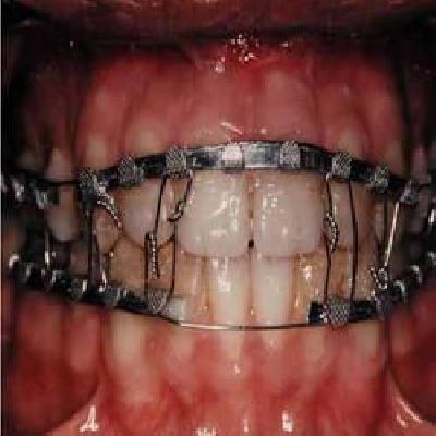 Maxillary Arch Bar