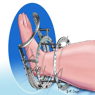 External Fixators