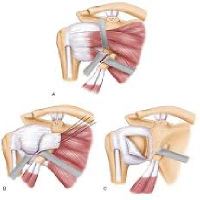 BioLatarjet (Latarjet / Coracoid Process Transfer) 