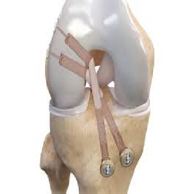 STAYFIX Spiked Ligament Staple