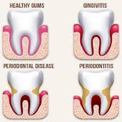Periodontal Jaw With Carious 