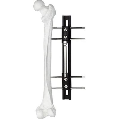 Limb Lengthening Fixator (L.R.S)