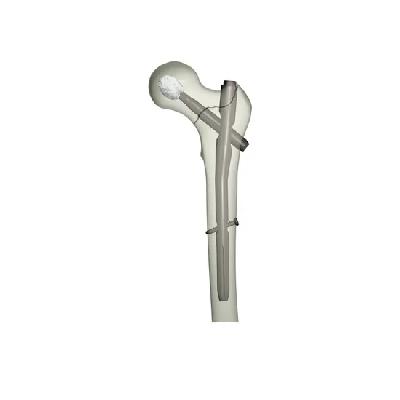 Proximal Femur Nail
