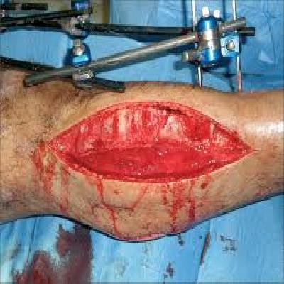 Blast Injury Due To Cylinder