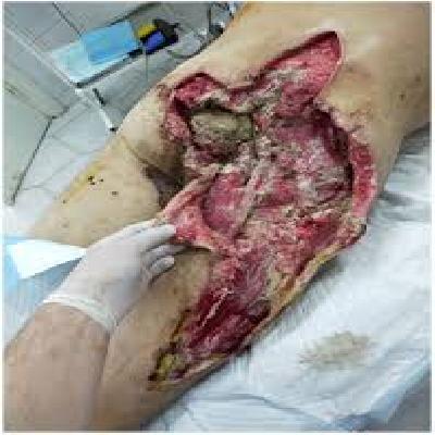 Blast Injury Forensic Model