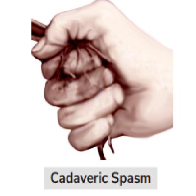 Codaveric Spasm Fig