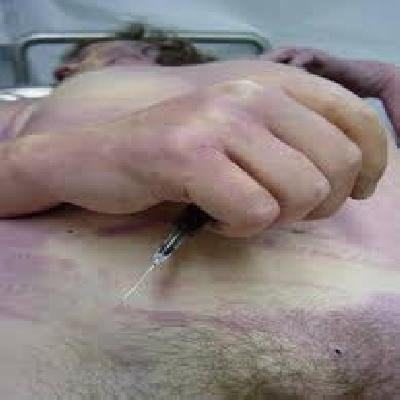 Codaveric Spasm Fig Forensic Model