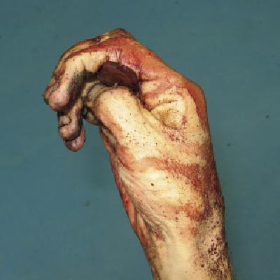 Codaveric Spasm Stifness Of The Firmally Grasped Hand