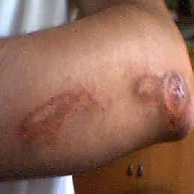 Crescentic Abrasions