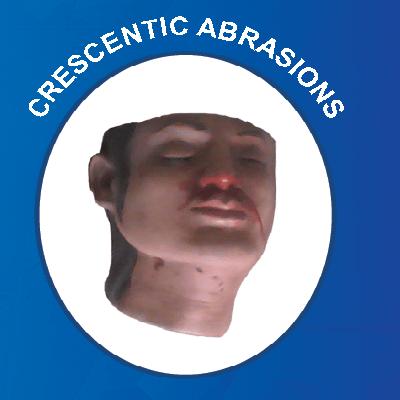 Crescentic Abrasions Forensic Model