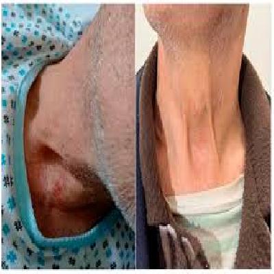 Forensic Model Strangulation