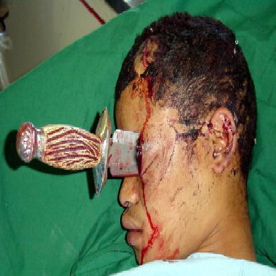 Injuries Nose Cut Off With Knife