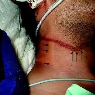 Ligature Mark On The Neck In Case Of Death By Hanging