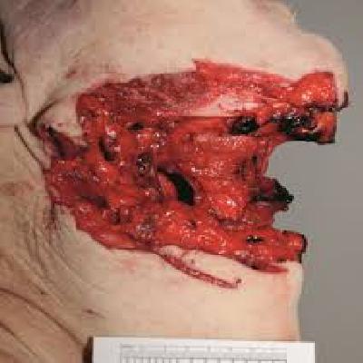 Nose Injuries with Knife Forensic Model